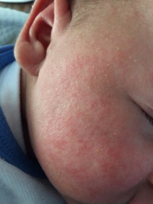 La costra láctea del bebé: qué es y cómo tratarla - Mustela Blog