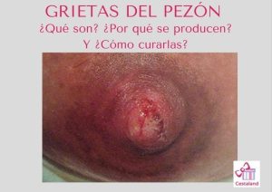 cómo quitar las grietas del pezón